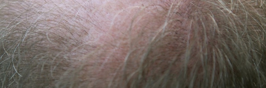 Patchy hair loss